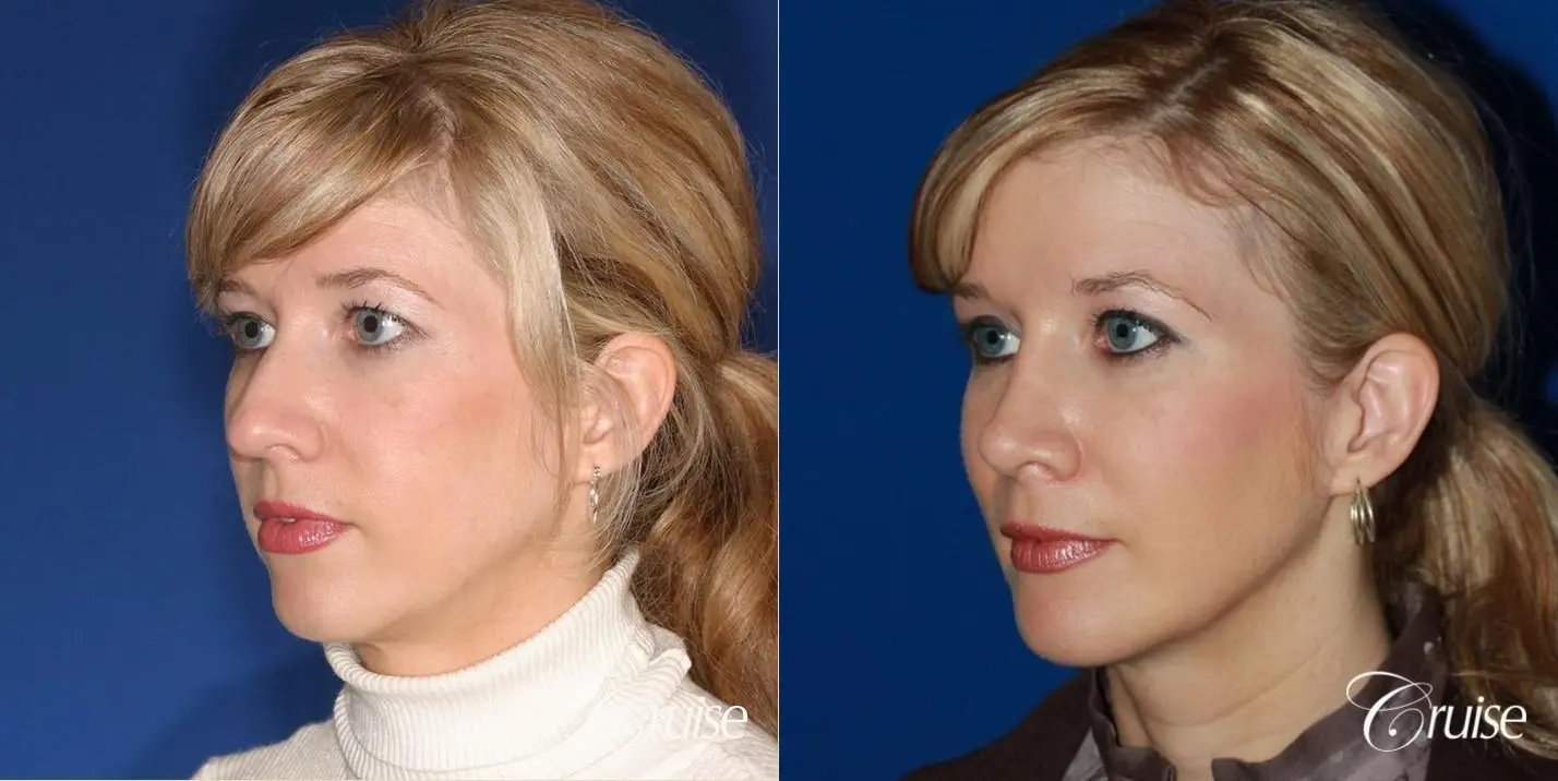 Rhinoplasty w/ Chin Augmentation & Temple Lift  - Before and After 2