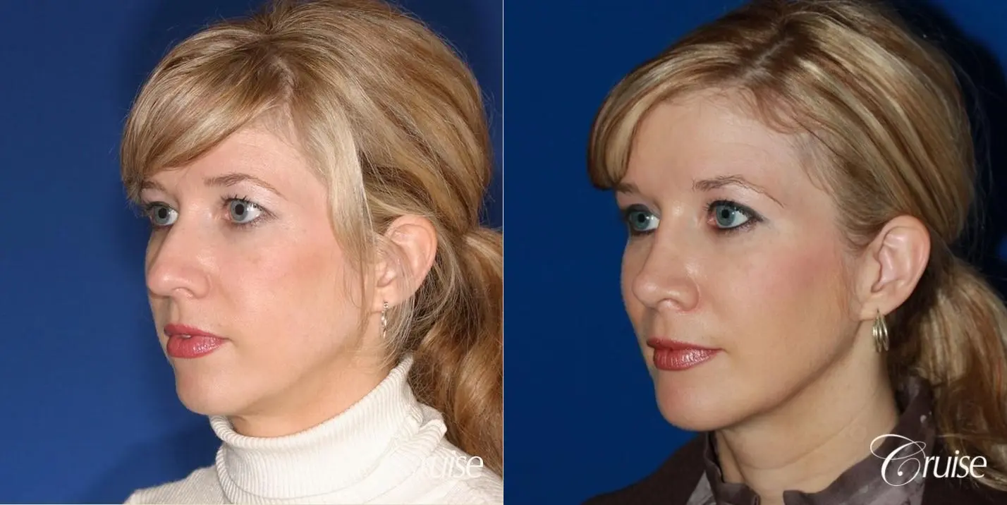 Rhinoplasty w/ Chin Augmentation & Temple Lift - Before and After 2