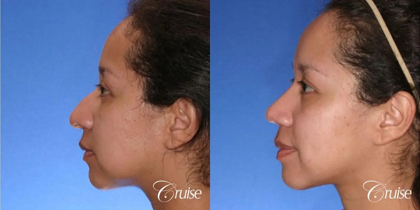 Rhinoplasty: Droopy, Narrow Tip Correction  - Before and After 2