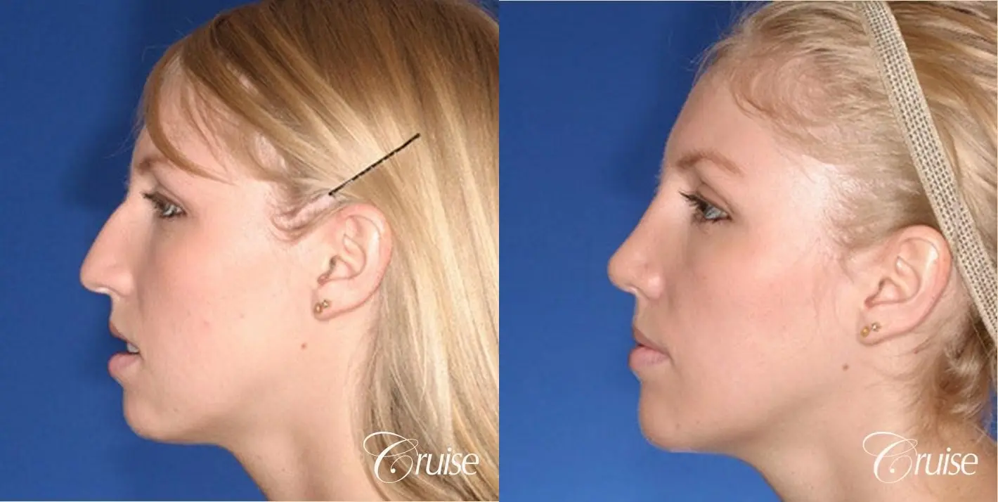 Rhinoplasty w/ Chin Augmentation: Hump Reduction  - Before and After 3