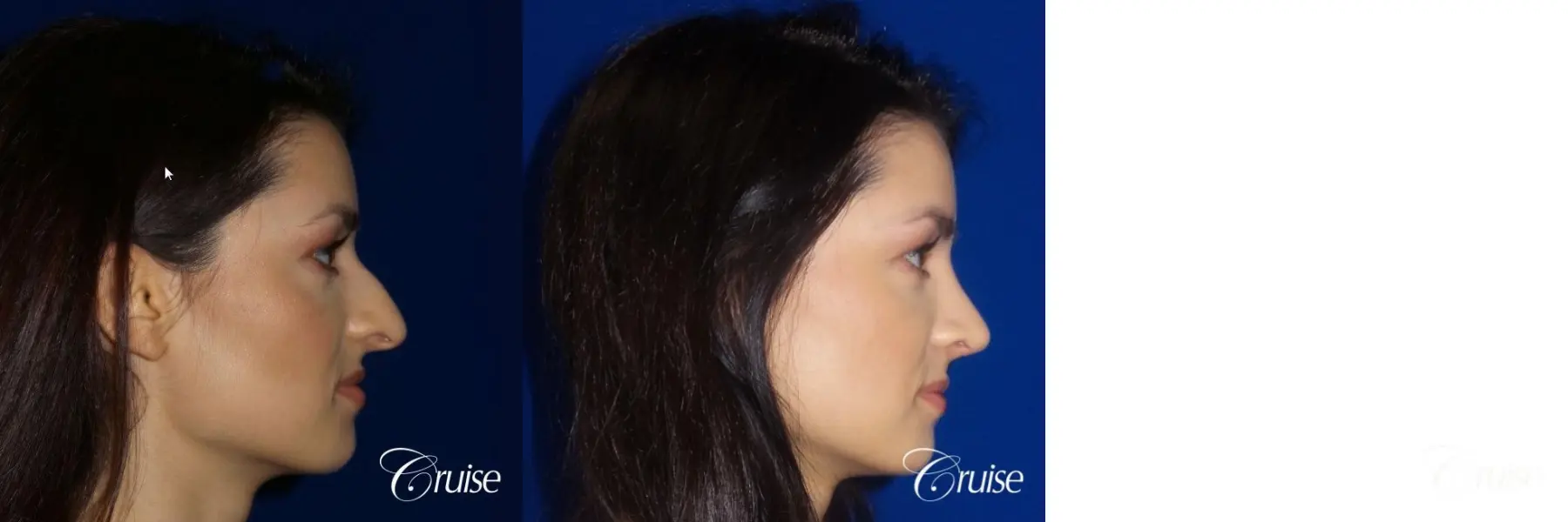 Rhinoplasty specialist Orange County CA - Before and After 4