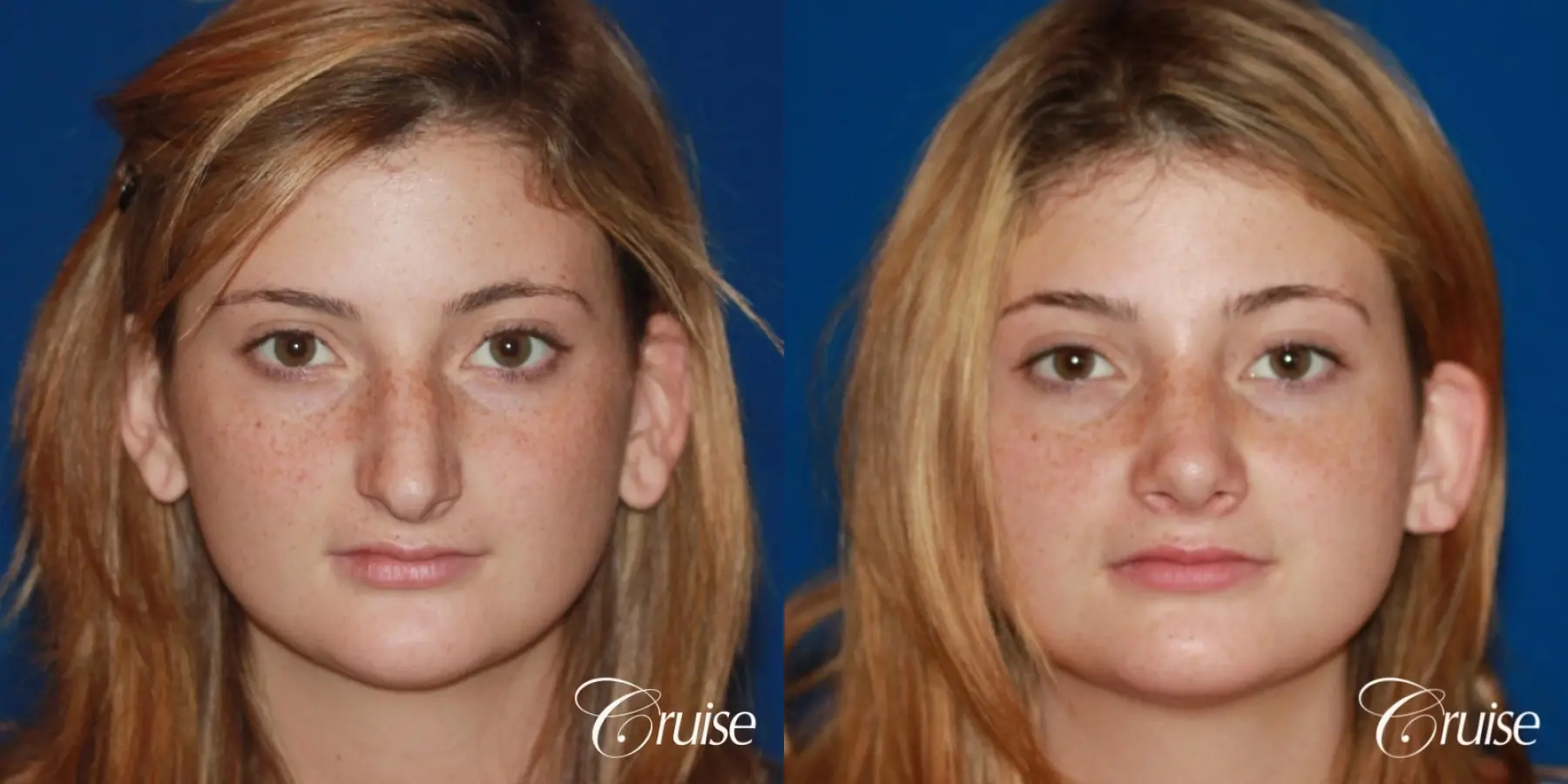 Rhinoplasty: Hump Reduction & Tip Shortening  - Before and After 1