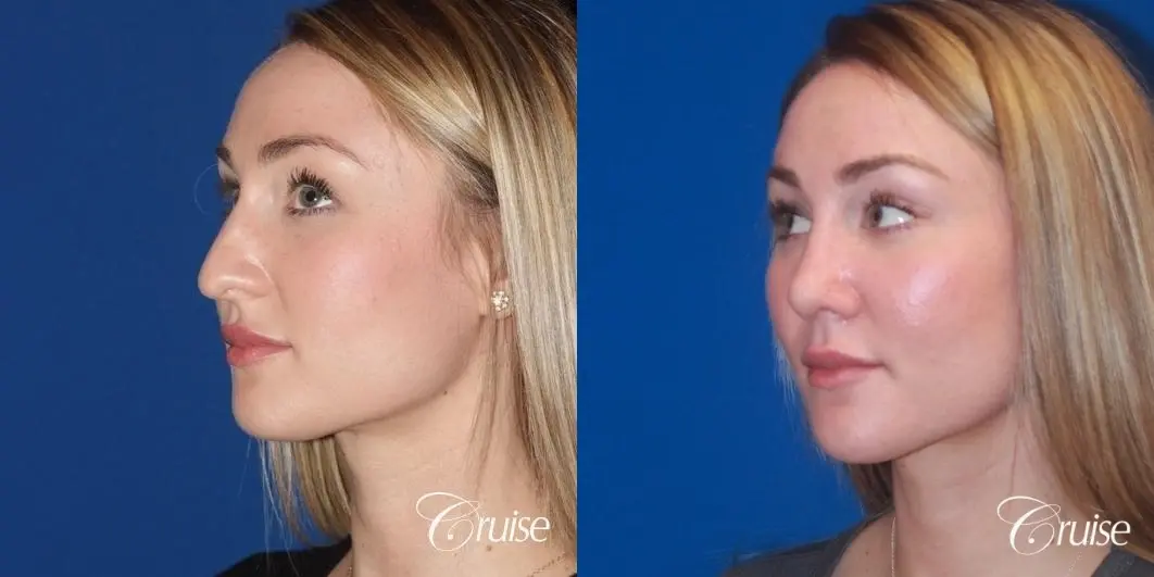 best rhinoplasty with natural results - Before and After 2