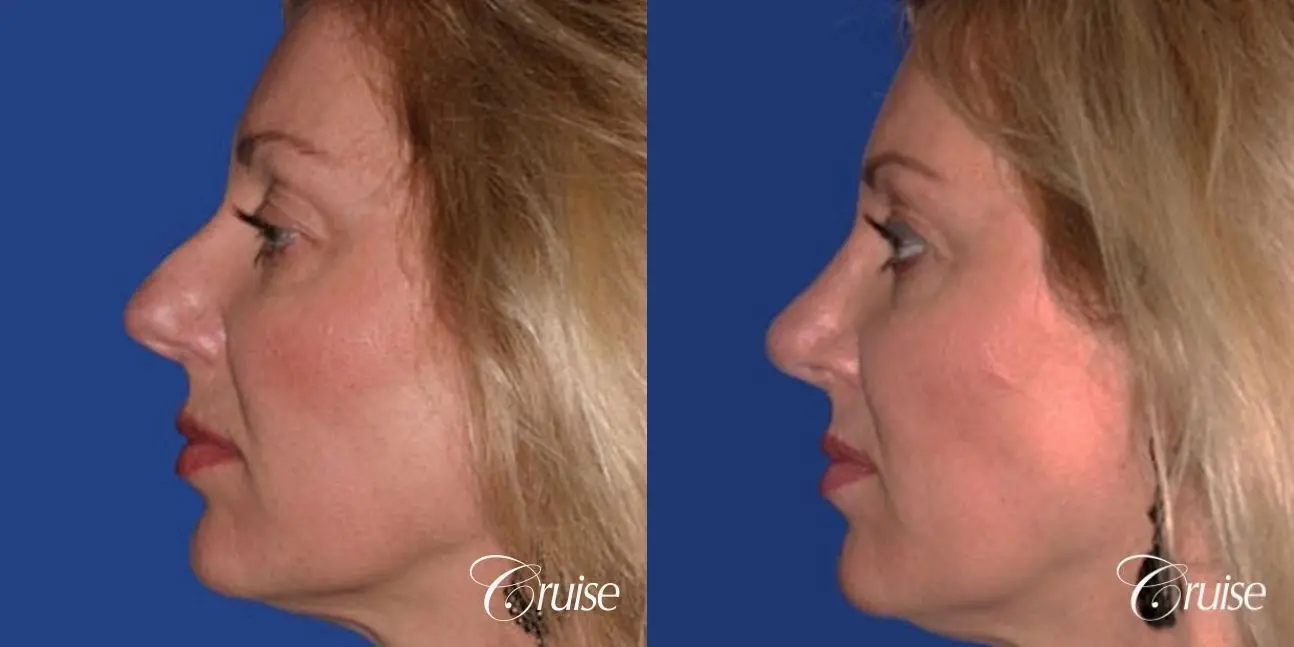 Rhinoplasty: Nose Reshaping  - Before and After 2
