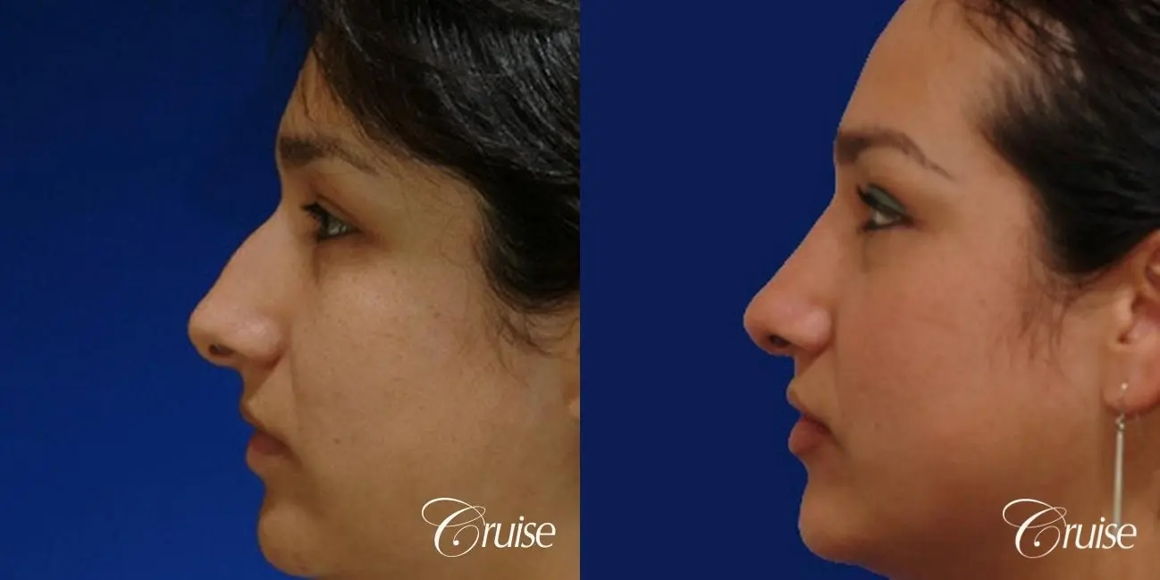 Rhinoplasty: Dorsal Hump Reduction  - Before and After 2