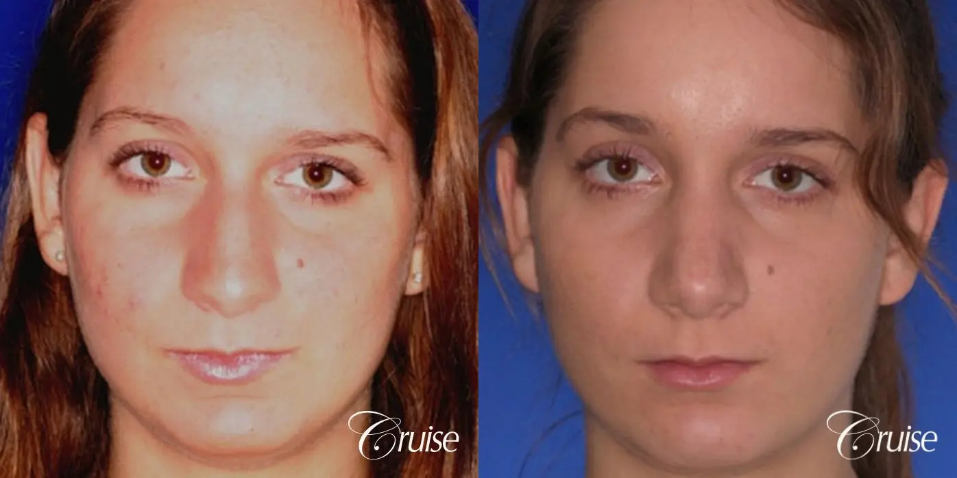 Rhinoplasty: Hanging Columella, Deviated Nose, Bulbous Tip Correction  - Before and After 1