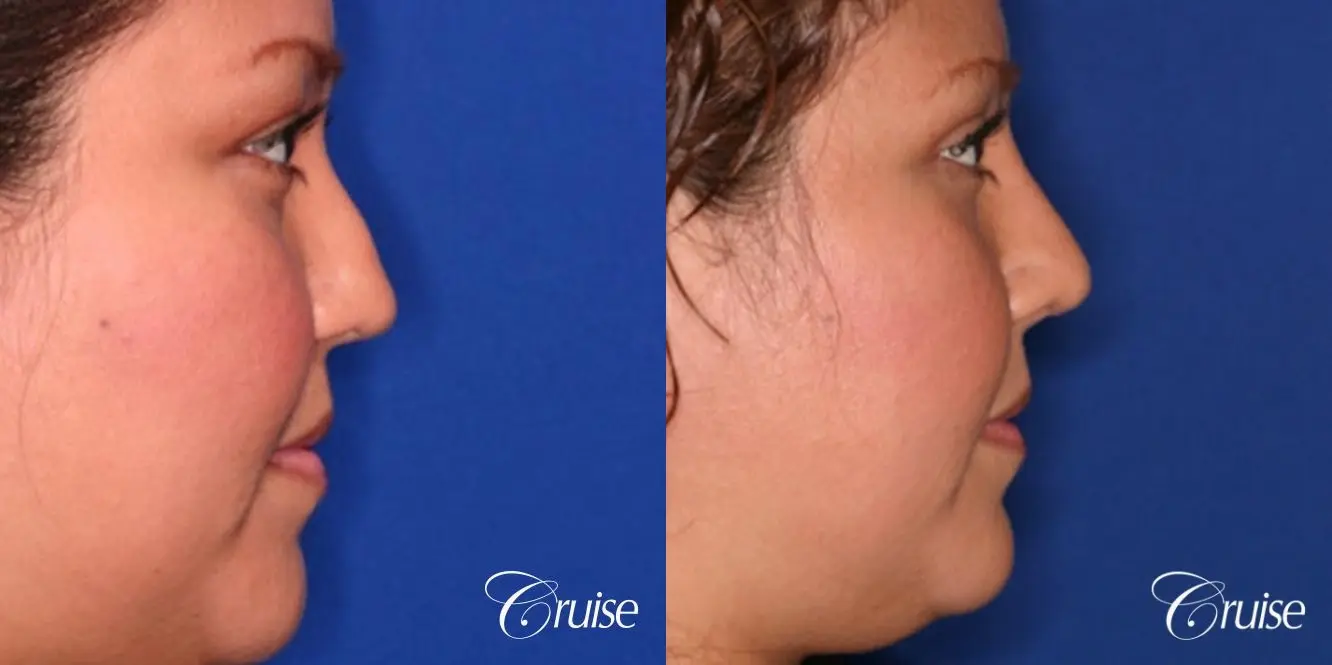 Rhinoplasty: Dorsal Hump Reduction  - Before and After 2