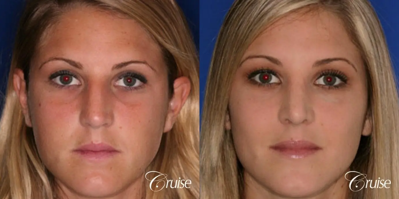 Rhinoplasty: Hump Reduction & Tip Narrowing  - Before and After 1