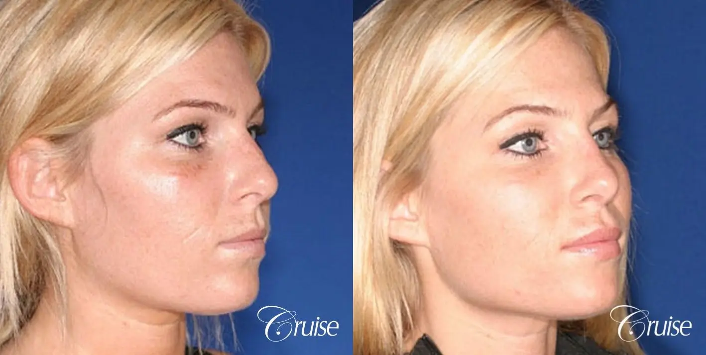 Rhinoplasty Revision: Tip Definition & Rotation  - Before and After 4