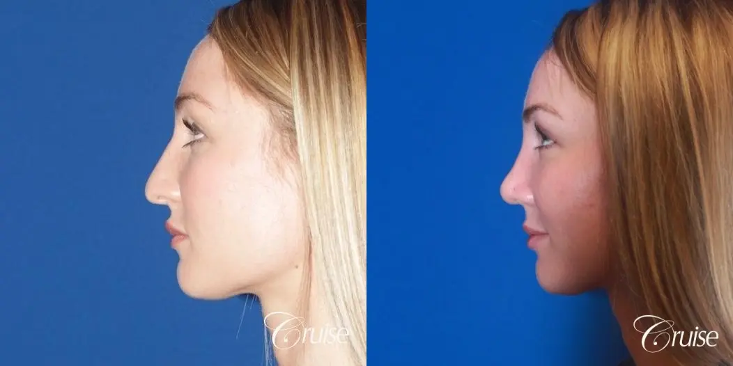 best rhinoplasty with natural results - Before and After 3