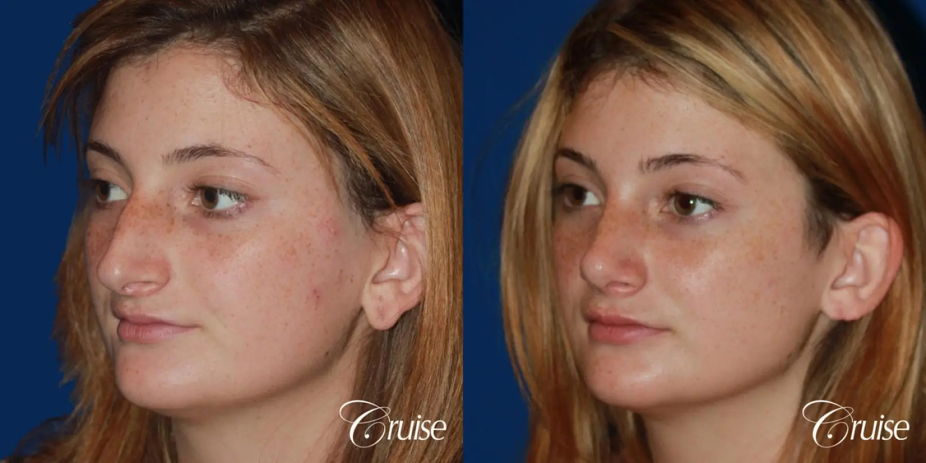 Rhinoplasty: Hump Reduction & Tip Shortening  - Before and After 3