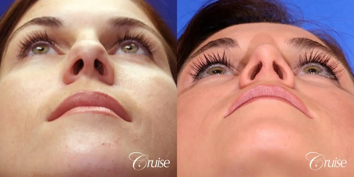 Rhinoplasty: Bulbous Tip Correction  - Before and After 2