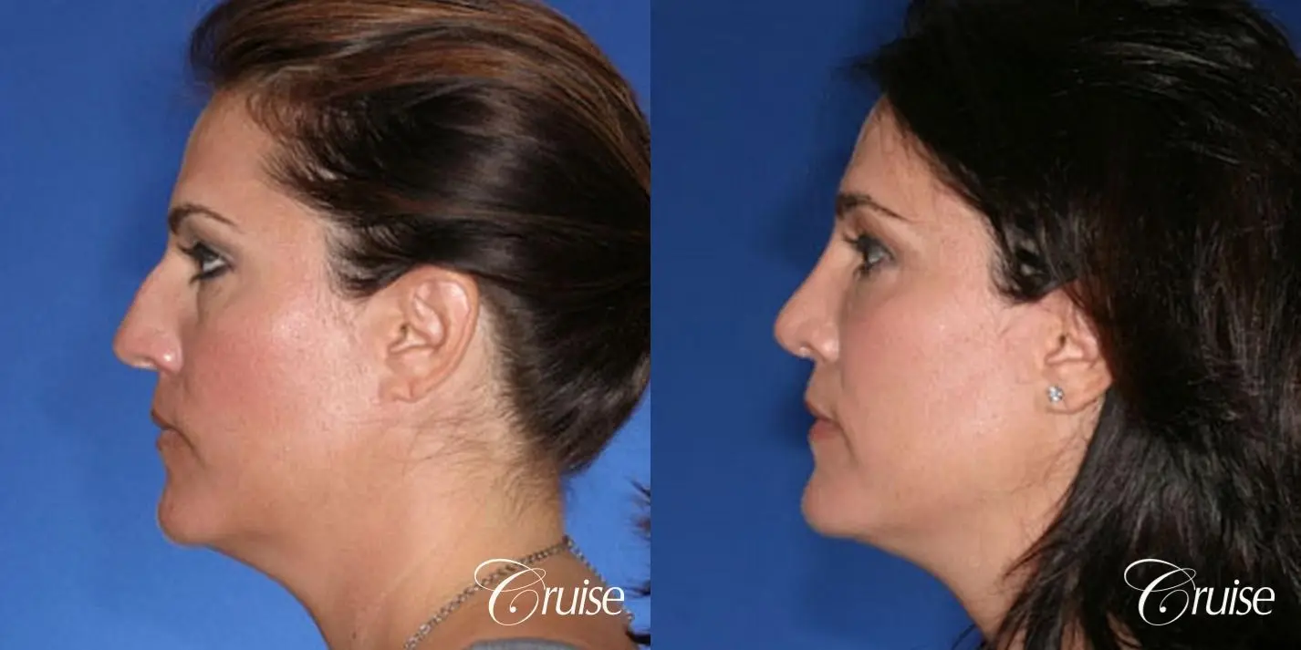 Rhinoplasty: Hump Reduction & Droopy Tip Correction  - Before and After 2