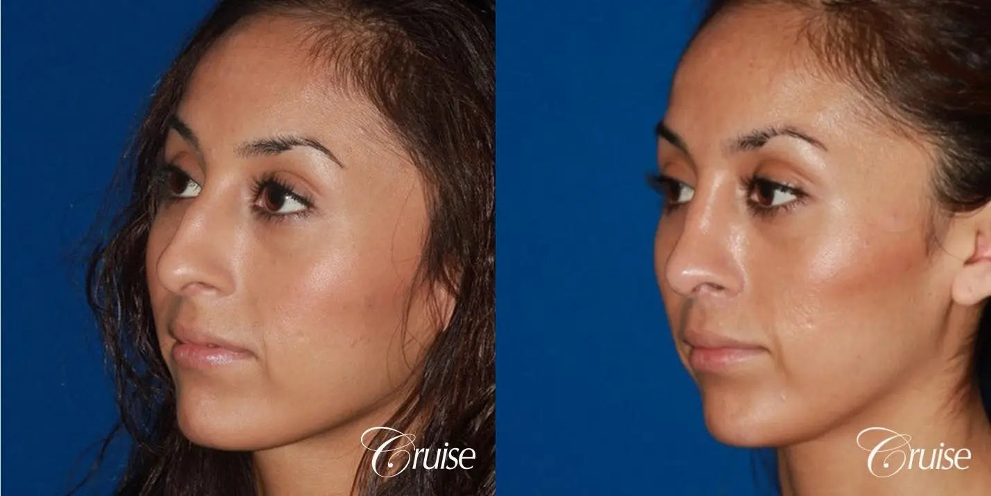 Rhinoplasty: Dorsal Hump Reduction & Droopy Tip Correction  - Before and After 3