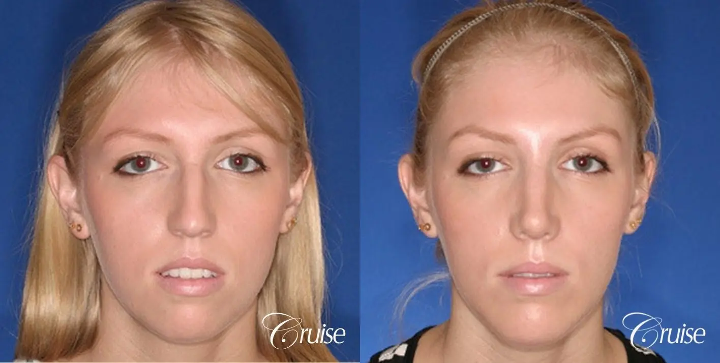 Rhinoplasty w/ Chin Augmentation: Hump Reduction  - Before and After 1