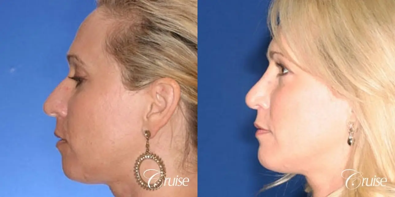 Rhinoplasty: Dorsal Hump & Droopy Tip Correction - Before and After 2