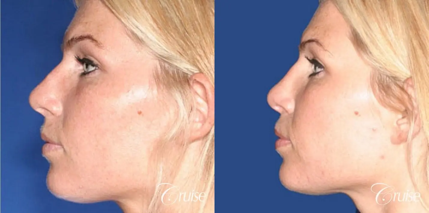 Rhinoplasty Revision: Tip Definition & Rotation  - Before and After 2