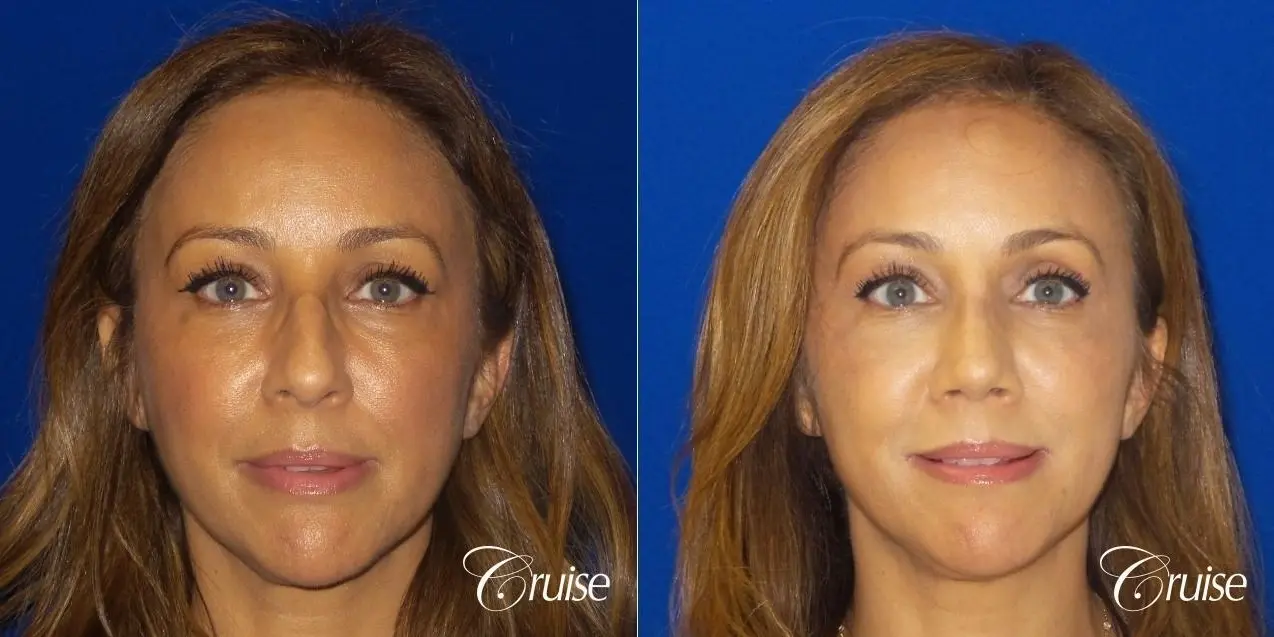 Rhinoplasty: Hump Reduction & Tip Shortening - Before and After 1