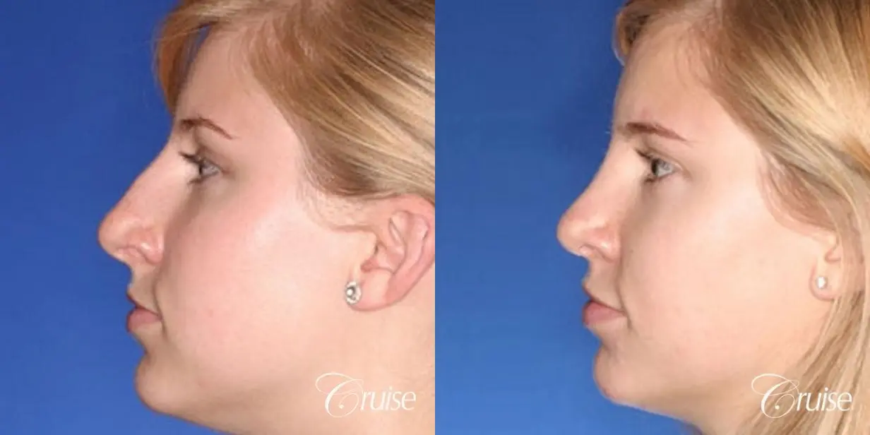 Rhinoplasty: Hump Reduction & Tip Narrowing  - Before and After 2