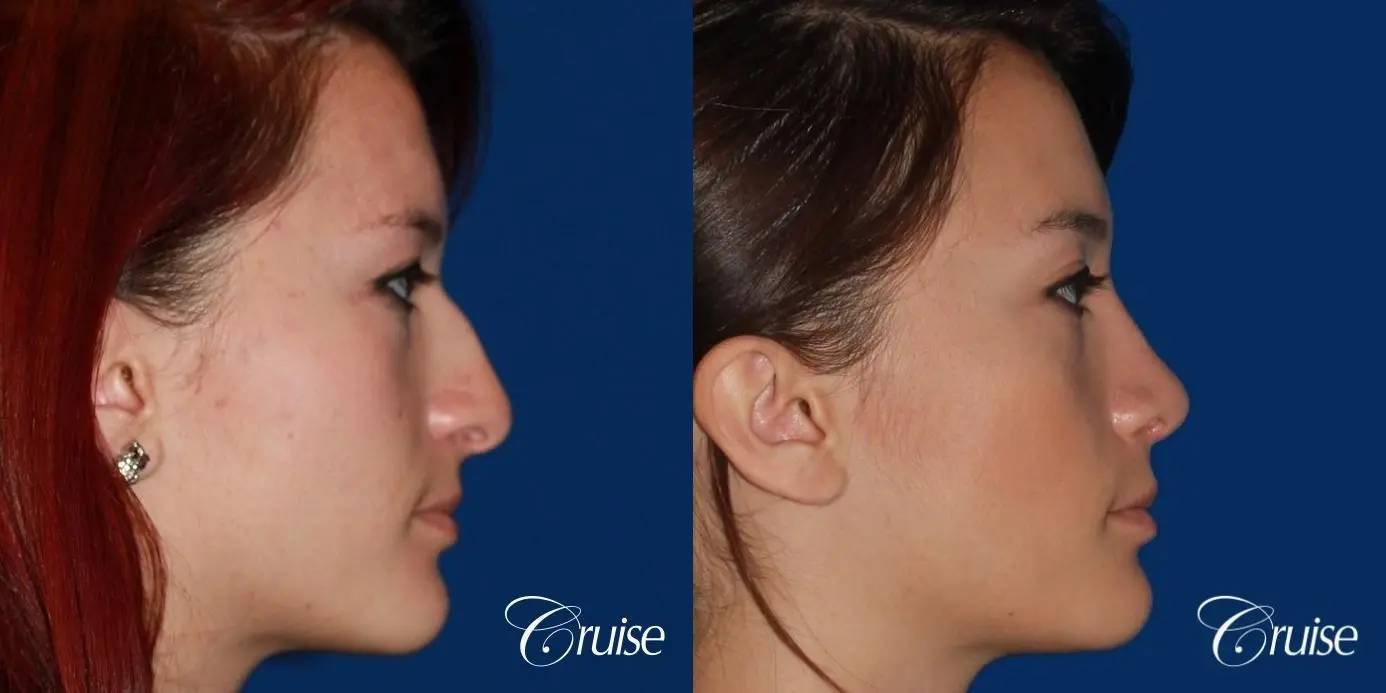 Rhinoplasty: Dorsal Hump Reduction  - Before and After 4