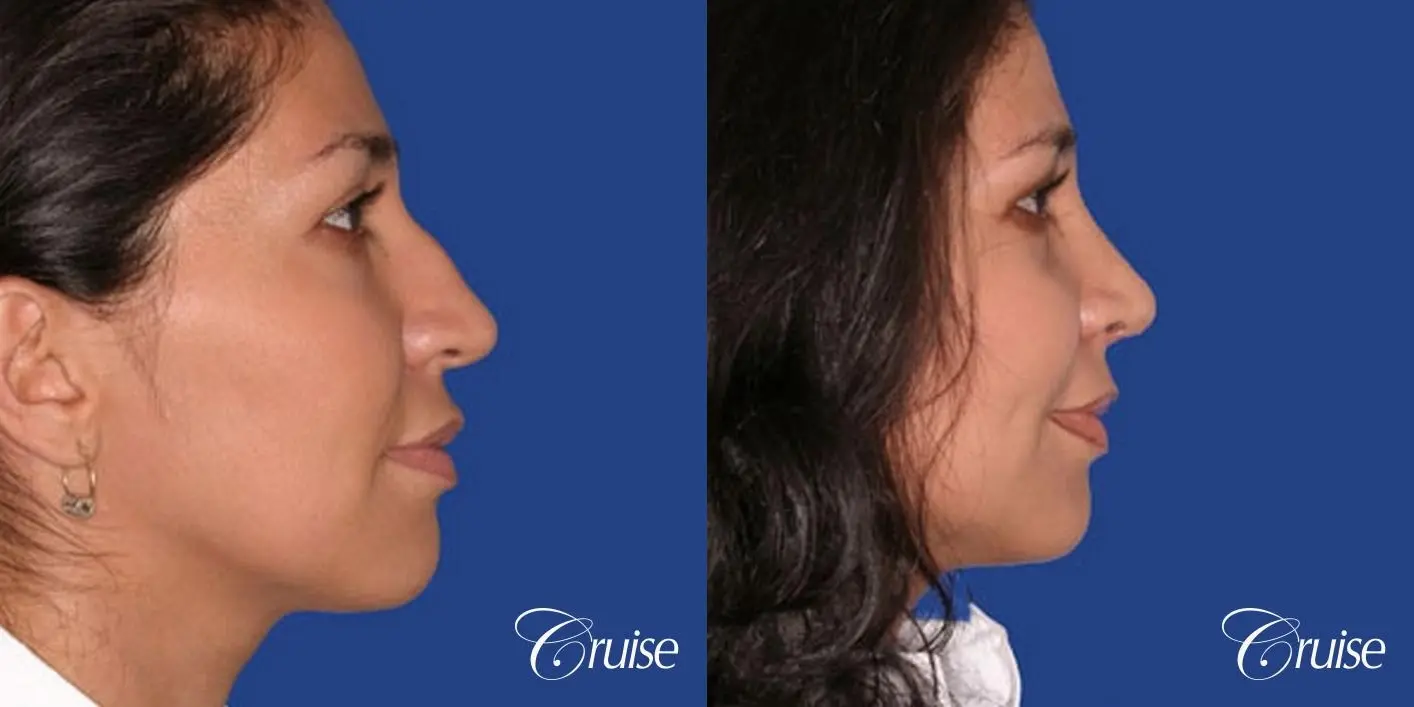 Rhinoplasty: Bridge Narrowing & Hump Reduction  - Before and After 2