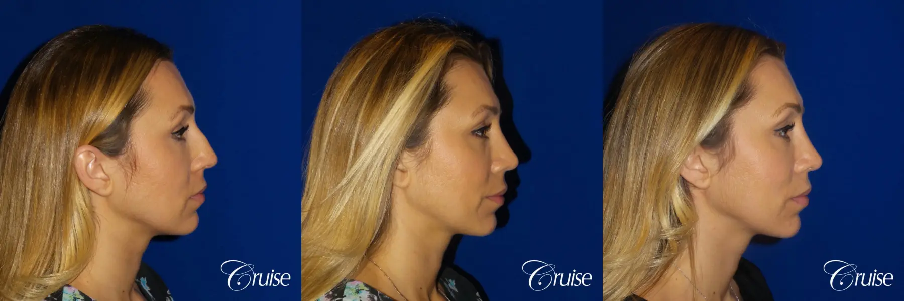 Rhinoplasty: Hump Reduction & Nasal Tip Refinement - Before and After 6