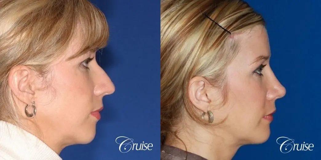 Rhinoplasty w/ Chin Augmentation & Temple Lift - Before and After 4