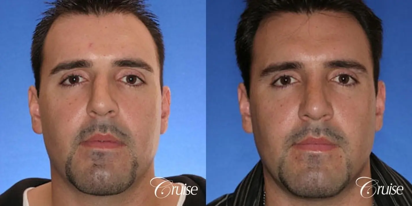 Rhinoplasty: Dorsal Hump Correction  - Before and After 1