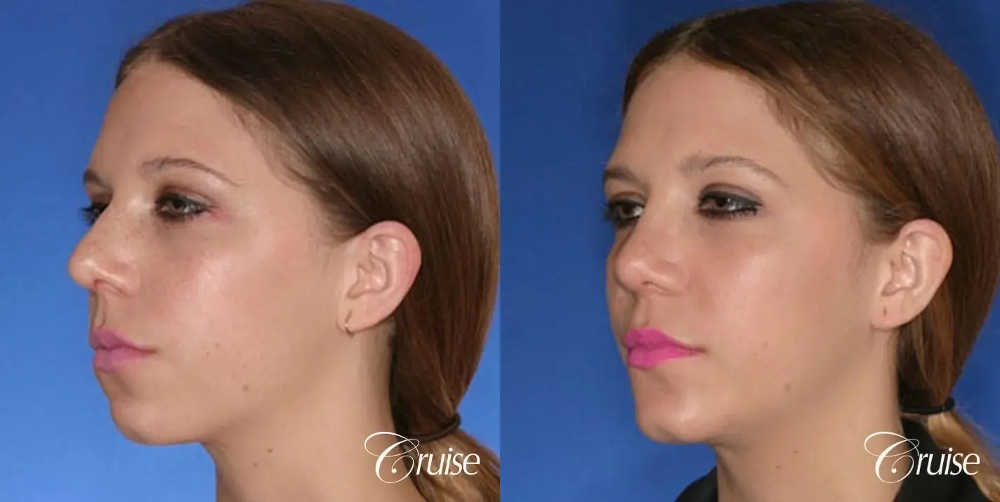 Rhinoplasty Revision w/ Chin Augmentation  - Before and After 2