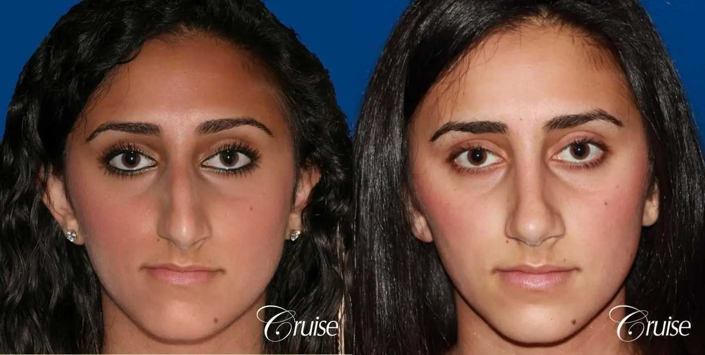 Rhinoplasty: Dorsal Hump Reduction  - Before and After 1