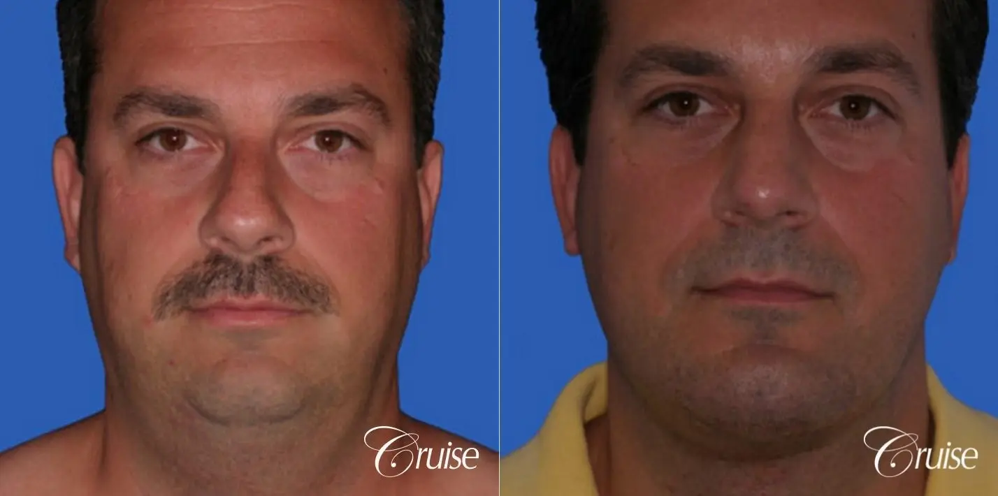 Rhinoplasty w/ Chin Augmentation and Neck Lift - Before and After 1