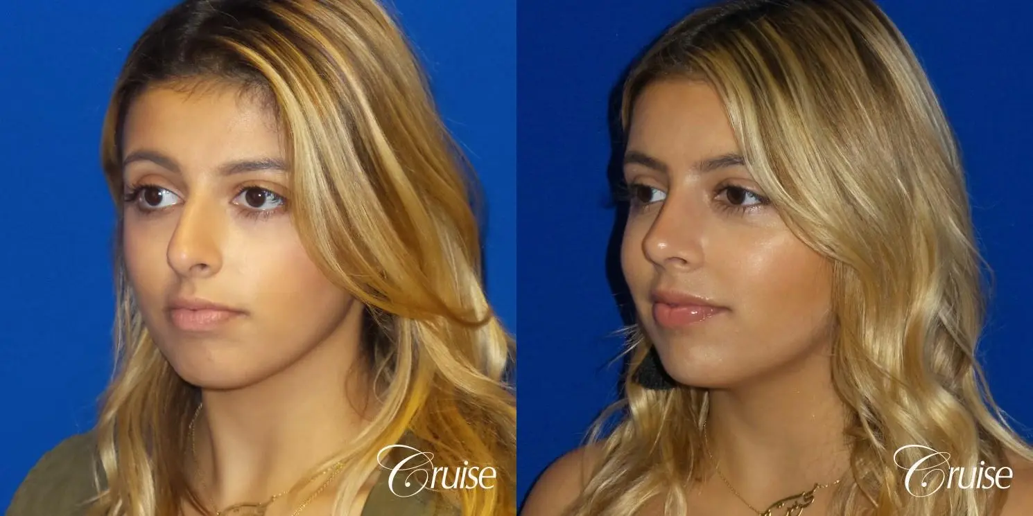 Rhinoplasty: Dorsal Hump & Droopy Tip Correction - Before and After 2