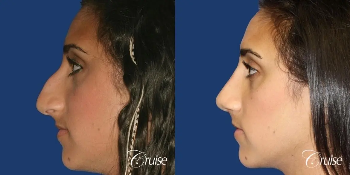 Rhinoplasty: Dorsal Hump Reduction  - Before and After 2