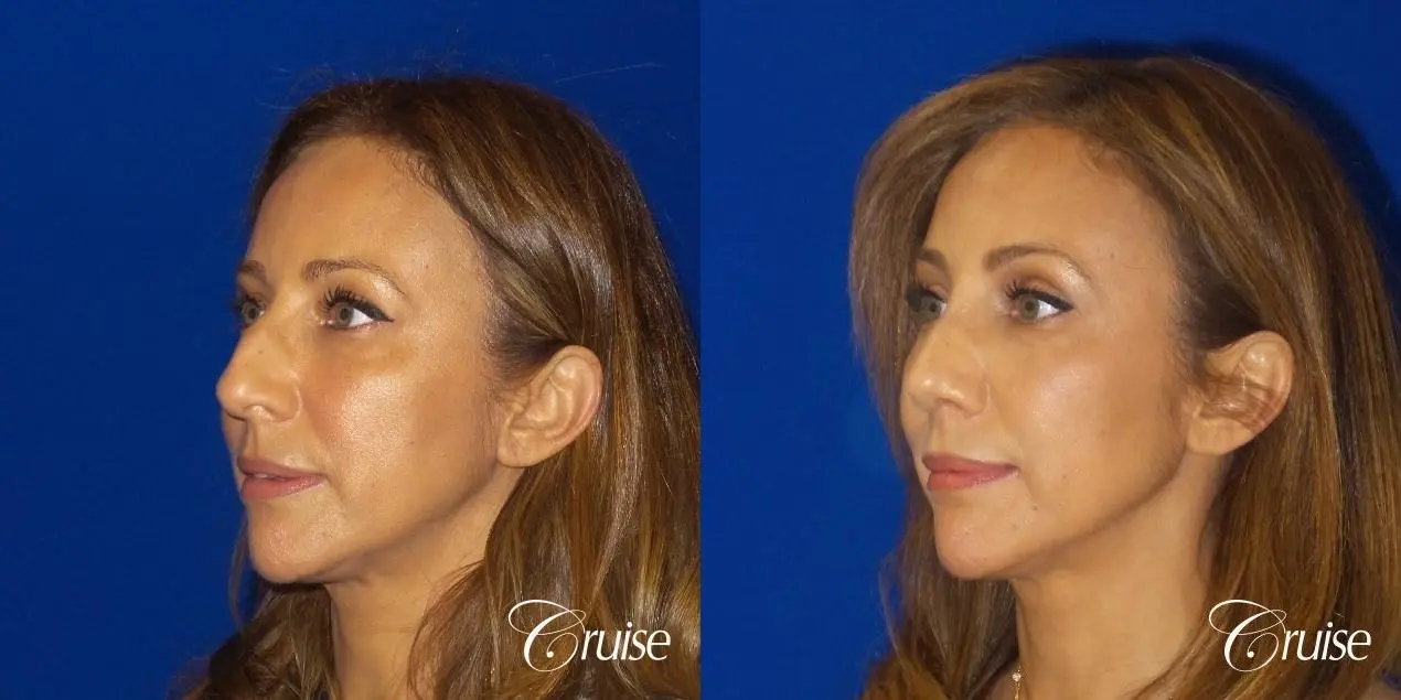 Rhinoplasty: Hump Reduction & Tip Shortening - Before and After 3