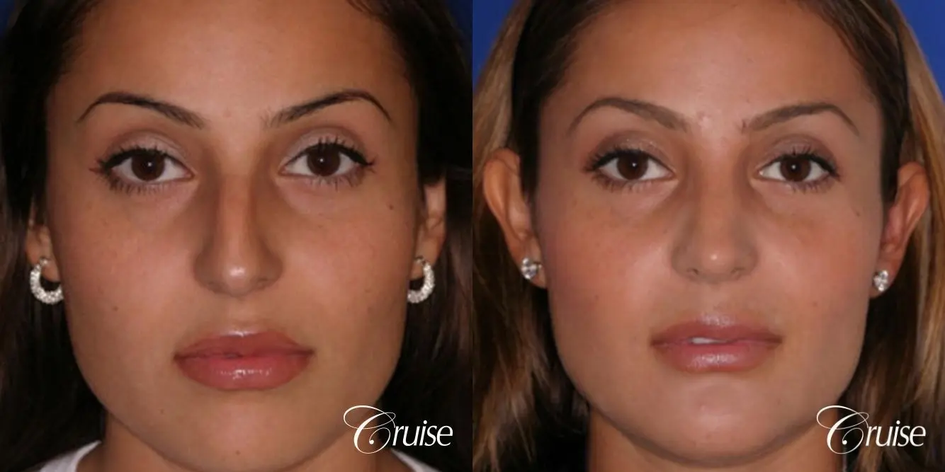 Rhinoplasty: Dorsal Hump Reduction - Before and After 1