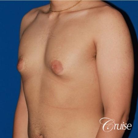 puffy nipple male breast on young adult - Before and After Image 3