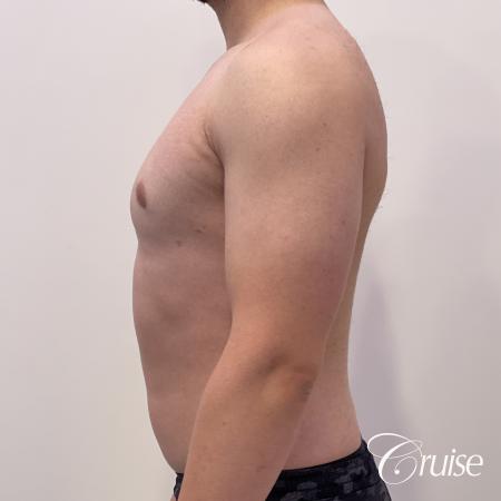 Gynecomastia: Patient 123 - After 3
