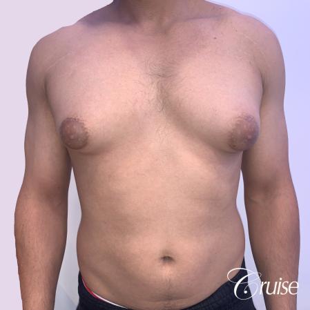 gynecomastia surgery - Before 1