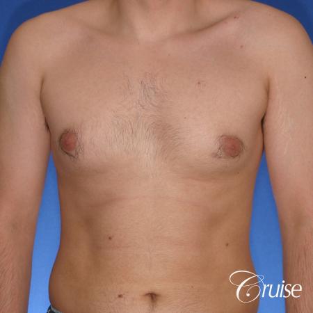 moderate gynecomastia puffy nipple - Before Image 1