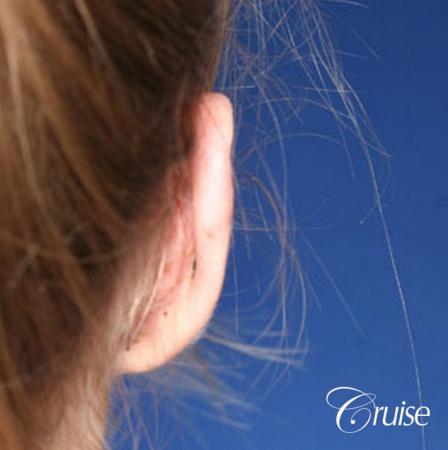 best otoplasty photos by top plastic surgeon - After Image 3