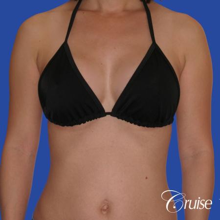 Breast Augmentation - After Image 4