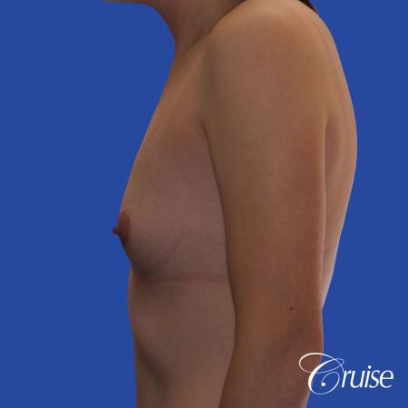 Breast Augmentation - Before Image 2