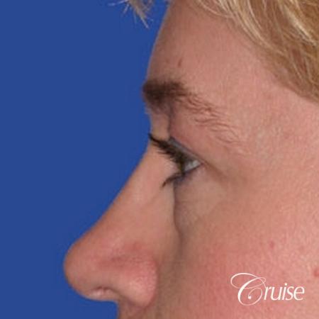best specialist for upper eyelid surgery - Before Image 2