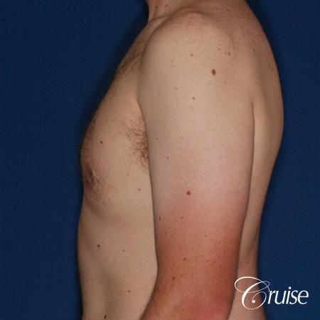 adult male with moderate gynecomastia gets donut lift - After Image 2
