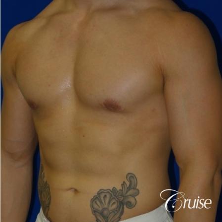 Body Builder Gynecomastia -Areola Incision - After Image 2