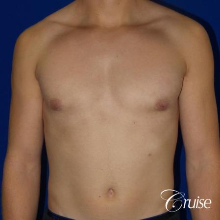 Mild Gynecomastia -Areola Incision - After Image 1