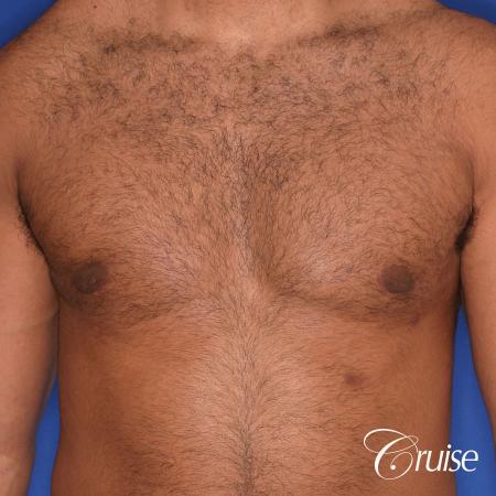 26 yo athletic patient with moderate gynecomastia - After Image 1