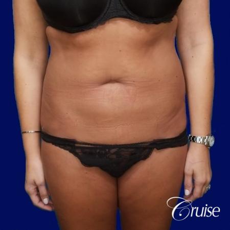 Liposuction Abdomen and Flanks with Midline Contour - Before Image 1