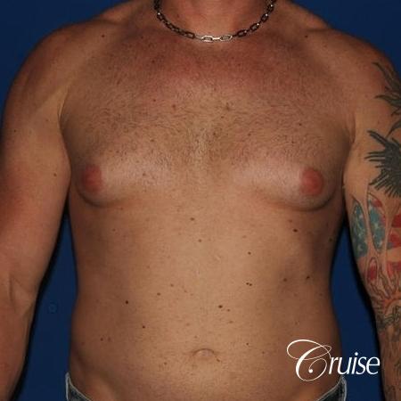moderate gynecomastia with puffy nipple on athletic adult - Before Image 1