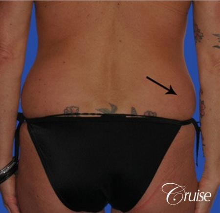 best female liposuction for small waist Newport Beach - Before Image 1